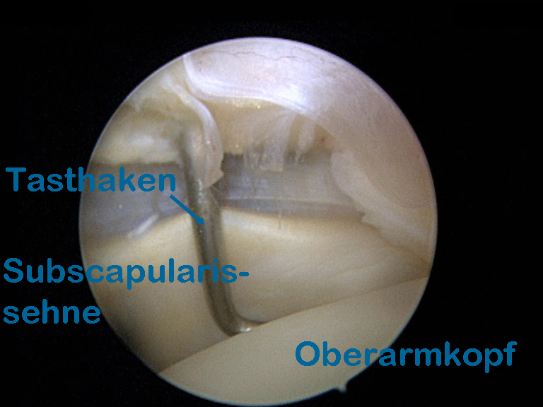 Musculus subscapularis